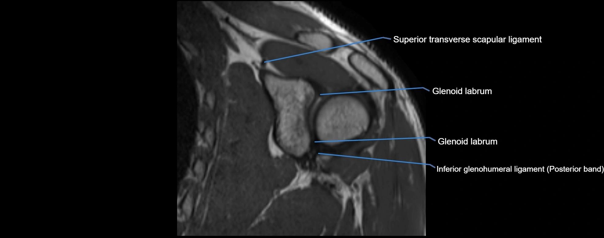 shoulder ligments coronal  cross sectional anatomy 3T MRI AI enhanced radiology image -img-00001-00031.webp